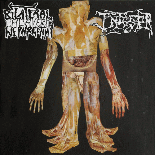 Infester (USA-2) : Infester - Bilateral Cadaveric Nephrectomy